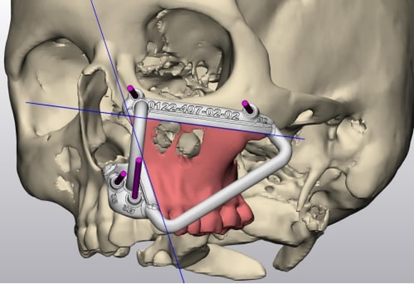 Операция на челюсти Операция на челюсти