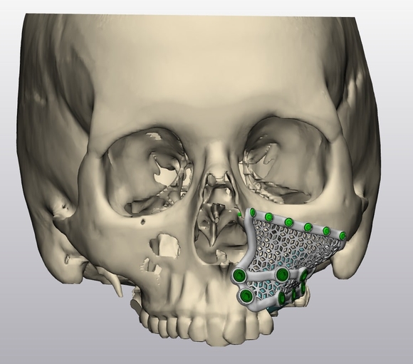 Операция на челюсти Операция на челюсти