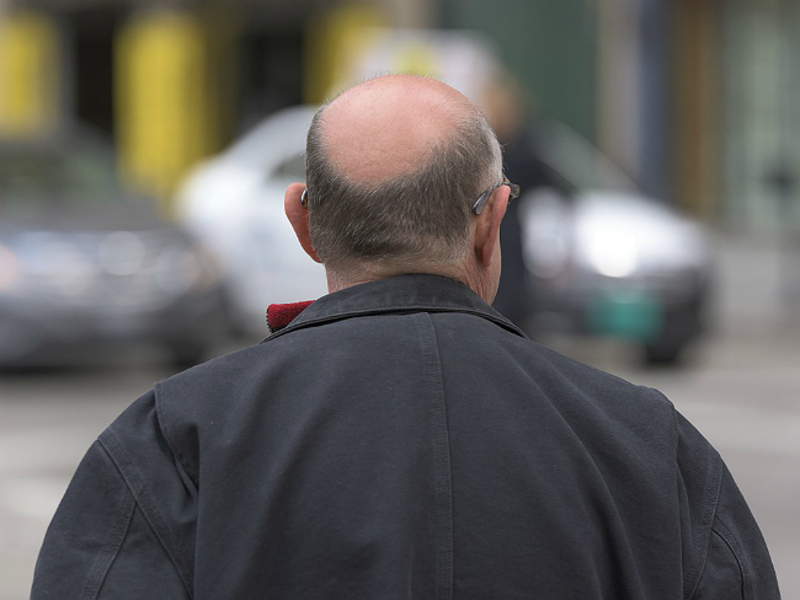 Scientists link hair loss to genital infection